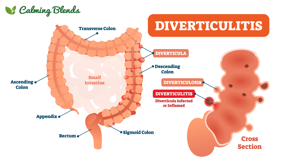 Diverticulitis Illustrated Diagram