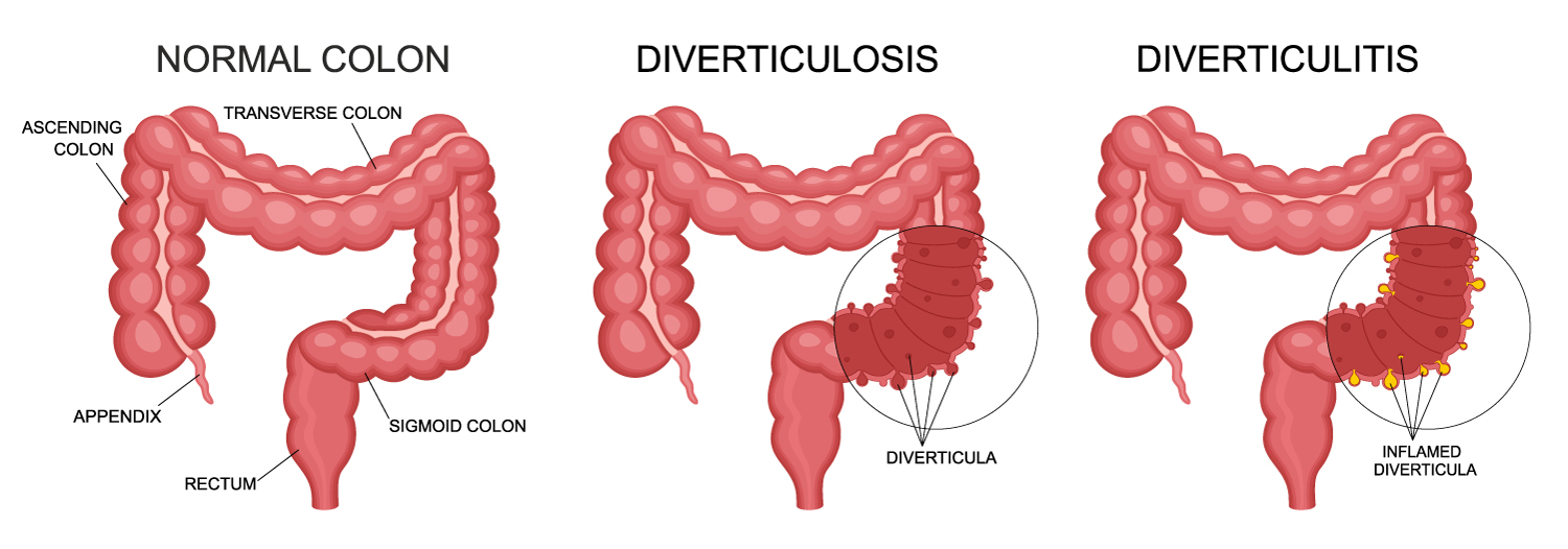 Normal colon vs. a colon with presence of Diverticulosis and another one depicting the presence of Diverticulitis with Flare-Ups