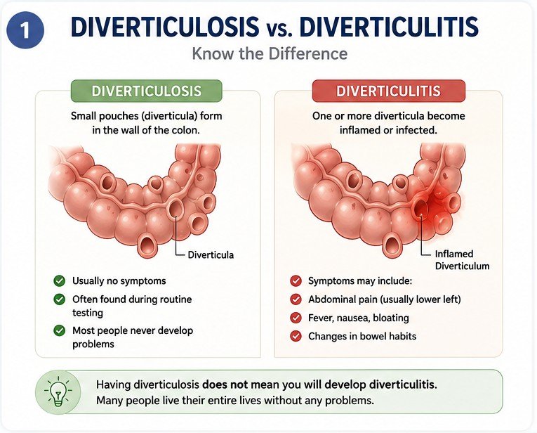 Diverticulosis vs Diverticulitis